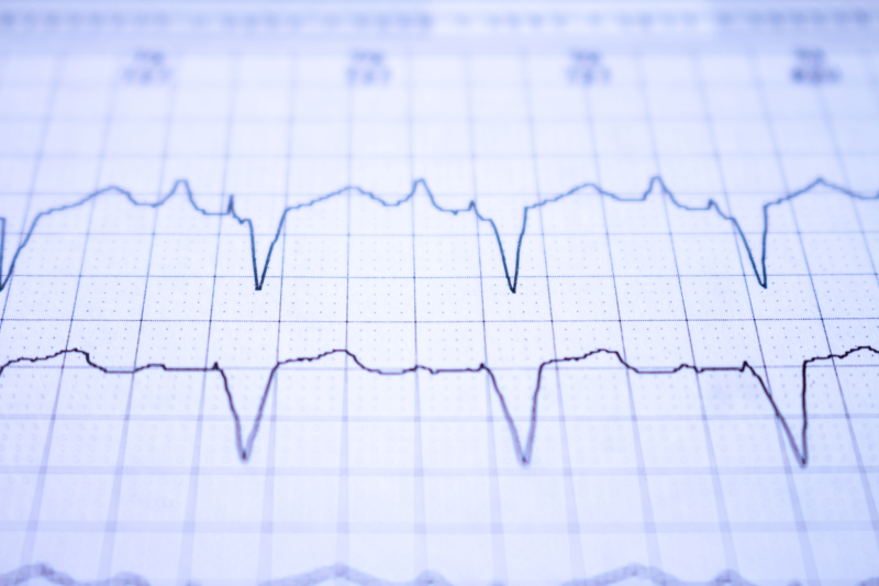 A patient's EKG being evaluated at Aspire's Cardiac rehabilitation Program